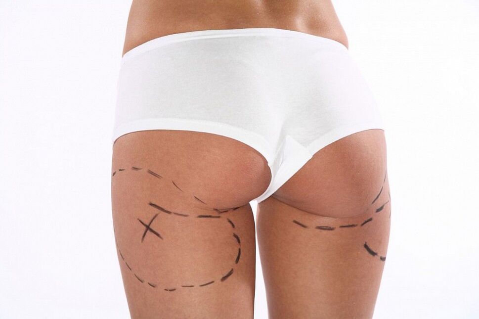 إجراءات التجميل لفقدان الوزن